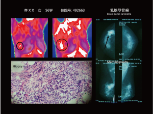 乳腺红外影像