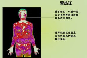 红外热成像技术为中医临床的六经辨证、八纲辨证、经络辨证、脏腑辨证提供可视化辅助诊断信息