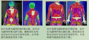 红外热成像技术对理疗效果疗效评价之一二