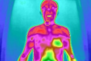 甲状腺疾病高发，红外热成像如何及早发现？