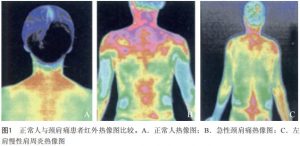 红外热成像技术在临床疼痛评定标准中的应用进展