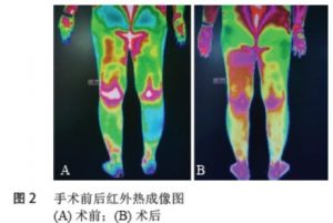 红外热成像应用浅析之红外热像图在评估椎间孔韧带松解术治疗腰椎间盘突出症疗效中的应用