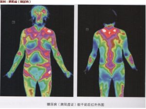 红外热成像技术–走进健康生活