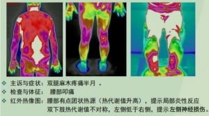 说不清楚道不明白的疼痛，怎么用医用红外热成像仪实现可视化？