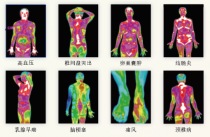 辅助诊断与疗效观察