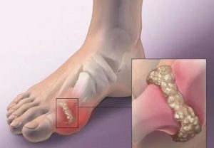 红外热成像在痛风性关节炎中的应用