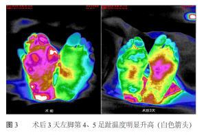 血栓疾病通过医用红外热成像技术诊断分析的重要意义