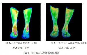 红外热像对关节腔内使用曲安奈德治疗痛风性关节炎的疗效评价