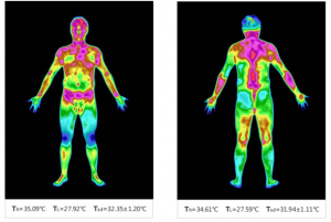 中医、治未病科建设的特色技术—医用红外热成像