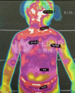 医用红外热成像在儿科领域的应用