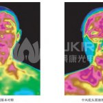 医用红外热像仪应用-中风早期检测 医用红外热像仪应用-中风早期检测