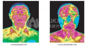 医用红外热像仪应用-中风早期检测 医用红外热像仪应用-中风早期检测