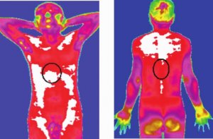 医用红外热成像技术对疾病的全过程监测
